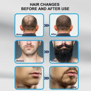 Titanium microneedling derma stamp for face scalp beard repair